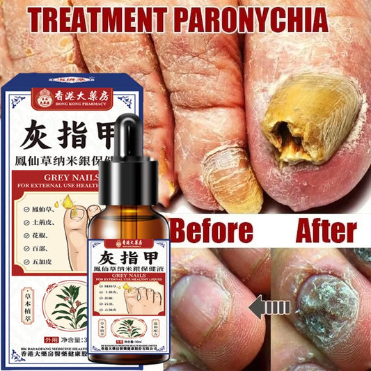 Nail Fungus Treatment Serum Foot Repair Liquid Toe Nails Fungal Removal Gel Anti Infection Paronychia Onychomycosis Cream 30ml